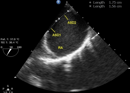 Transesophageal Echocardiogram In Atrial Septal Defect Echocardiogram