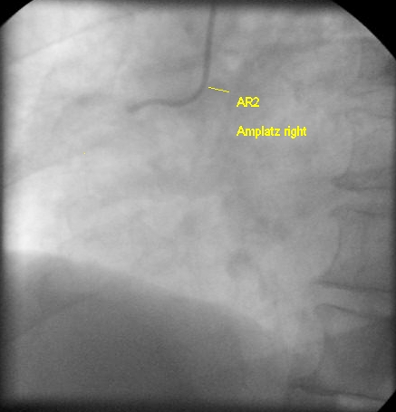 Amplatz right coronary catheter