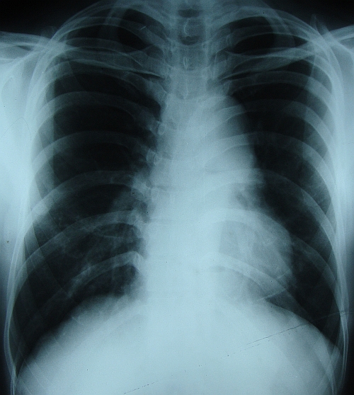 Aneurysm of proximal descending thoracic aorta on X-ray chest PA view ...