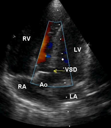 Apical five chamber view in Tetralogy of Fallot