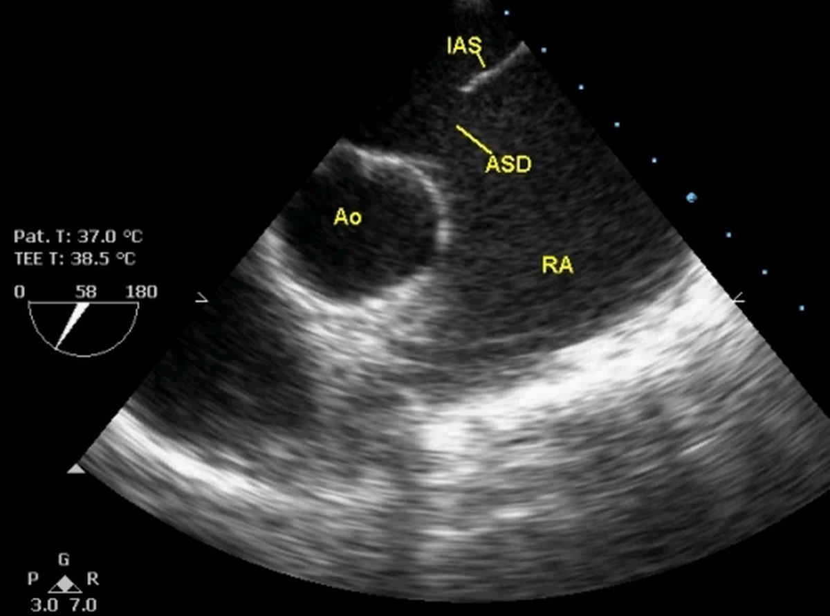 Atrial septal defect on transesophageal echocardiography