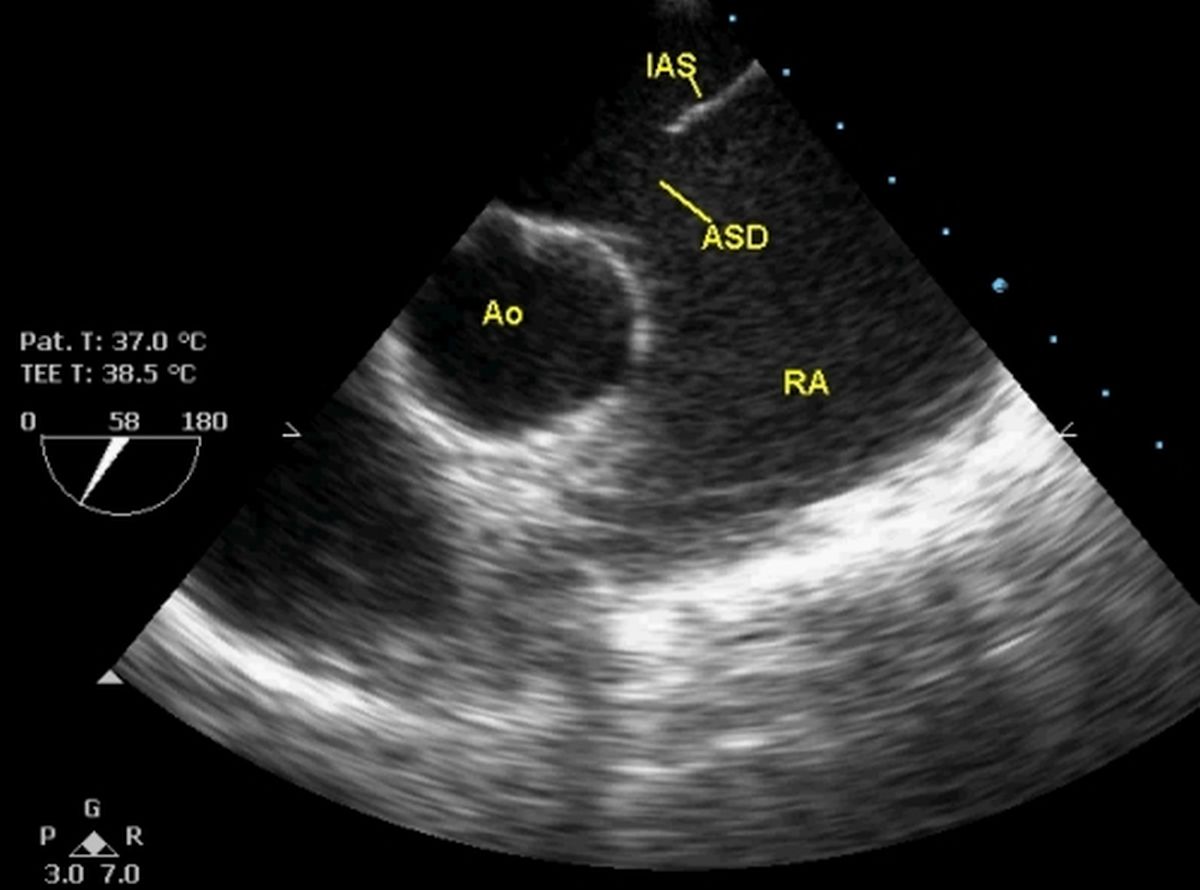 Atrial Septal Defect Ultrasound