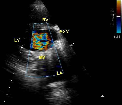 Turbulent mitral flow through the prosthetic mitral valve