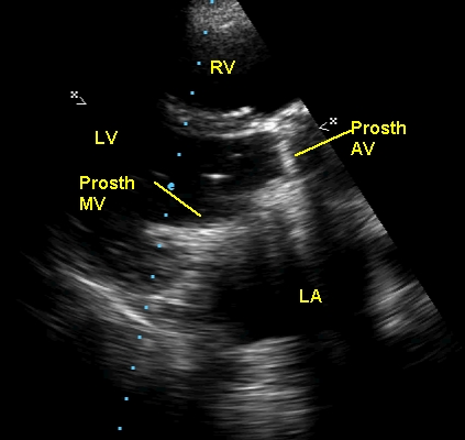 Prosthetic mitral and aortic valves in PLAX view on echo
