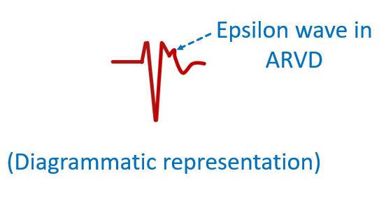 Diagrammatic representation of Epsilon wave in ARVD