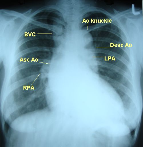 Dilated aorta with unfolding of arch on X-ray chest PA view - annotated