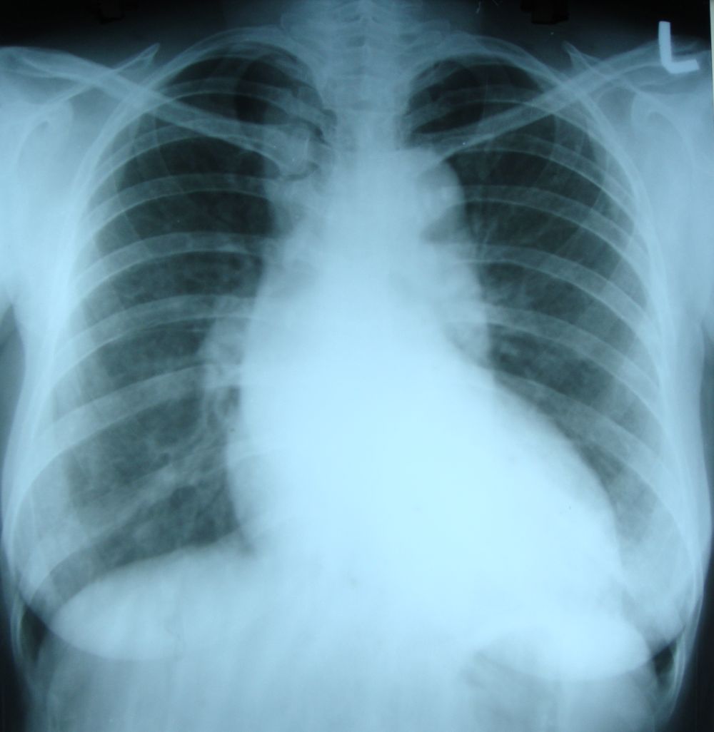 Dilated aorta with unfolding of arch on X-ray chest PA view