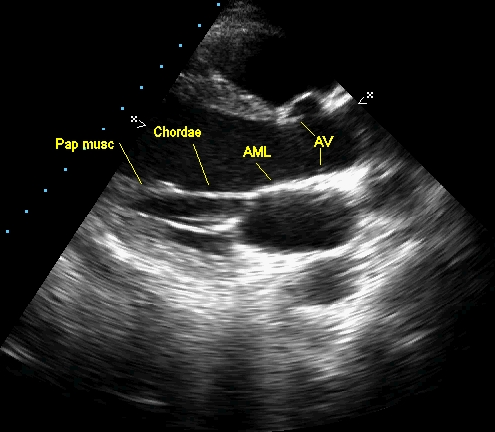 Echocardiogram in parasternal long axis view 2