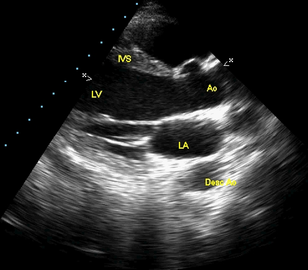 Echocardiogram in PLAX view with video