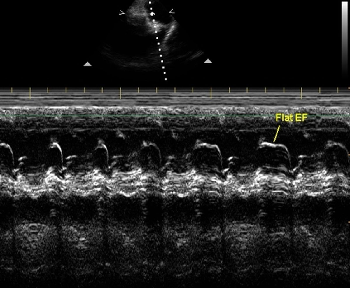 Echocardiographic profile in pulmonary hypertension