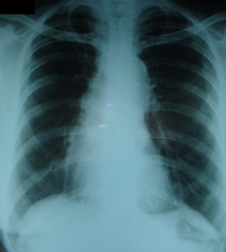 Intimal calcification in aortic knuckle - displacement taken as calcium ...