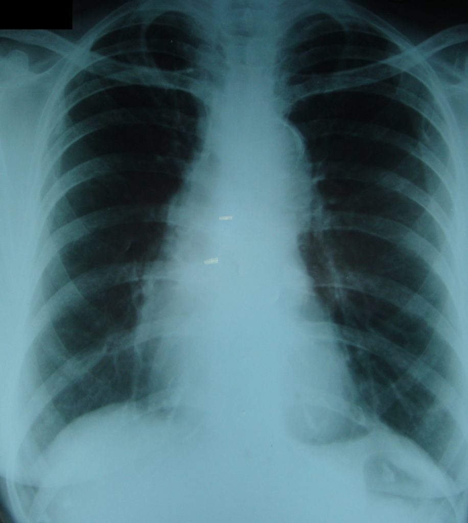 Intimal calcification in aortic knuckle - X-ray chest PA