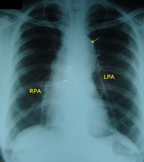 Intimal calcification in aortic knuckle - X-ray chest PA - annotated
