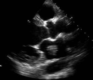 LA-Myxoma-PLAX-view – All About Cardiovascular System and Disorders