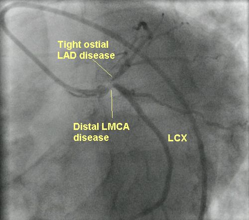 LMCA distal and tight LAD disease LAO caudal view - annotated