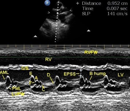 M-mode echo in left ventricular dysfunction due to anthracycline related cardiomyopathy - annotated