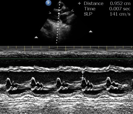 M-mode echo showing B hump in mitral valve tracing
