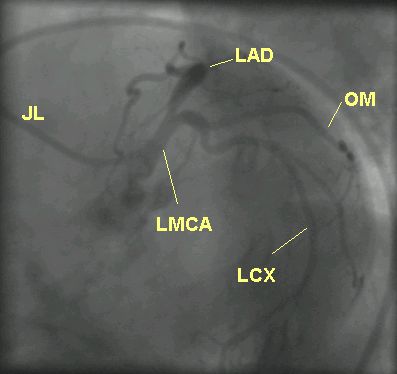 Left coronary angiogram in left anterior oblique (LAO) caudal view