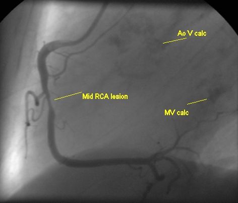Mid right coronary artery lesion plus mitral and aortic valve calcification