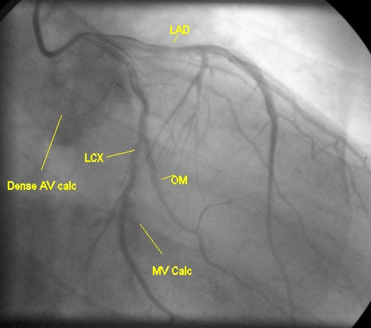 Mitral and aortic valve calcification and LCA angiogram