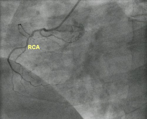 Non dominant right coronary artery