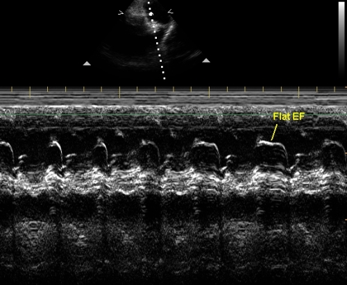 Flat EF slope on M-mode echocardiogram of pulmonary valve in pulmonary hypertension