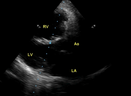 Parasternal long axis view of echocardiography in pulmonary hypertension