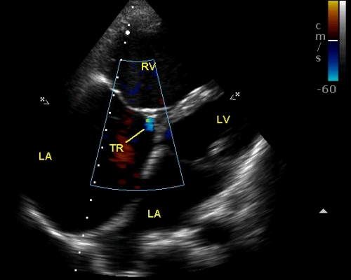 Trivial tricuspid regurgitation in PAH