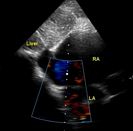 Subcostal view with colour flow mapping in PAH