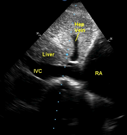 Dilated IVC in sub costal view of echocardiography