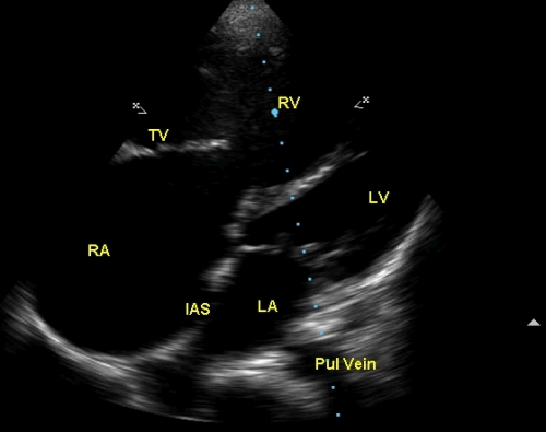  Modified apical four chamber view showing dilated right ventricle and right atrium