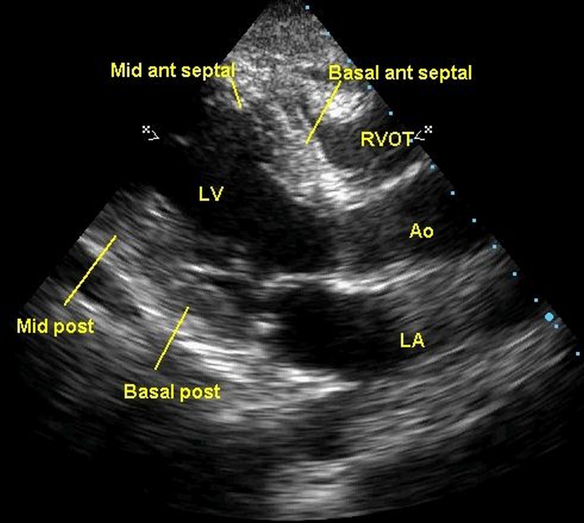 Regional wall motion abnormalities in coronary artery disease