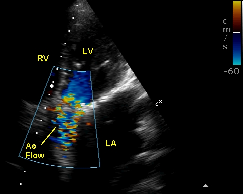 Turbulent aortic flow in prosthetic aortic valve
