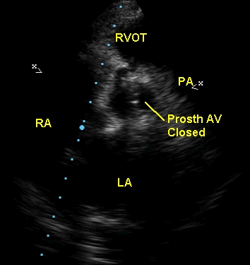 Prosthetic aortic valve in closed position seen on echocardiogram