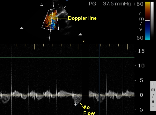 Gradient across prosthetic aortic valve on Doppler evaluation