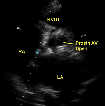 Open position of prosthetic aortic valve