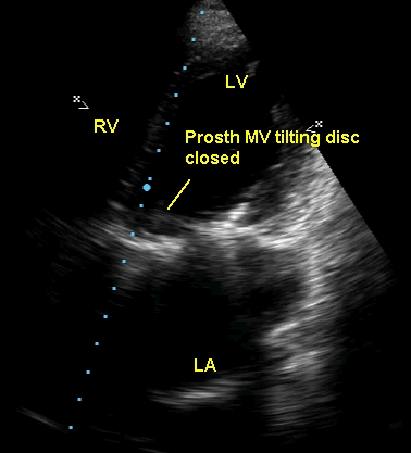 Prosthetic mitral valve with tilting disc in closed position