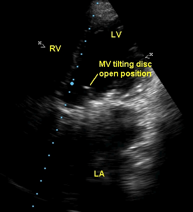 Prosthetic mitral valve with tilting disc in open position