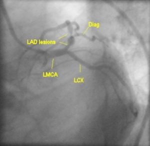 Proximal and mid LAD lesions in LAO caudal view – All About ...