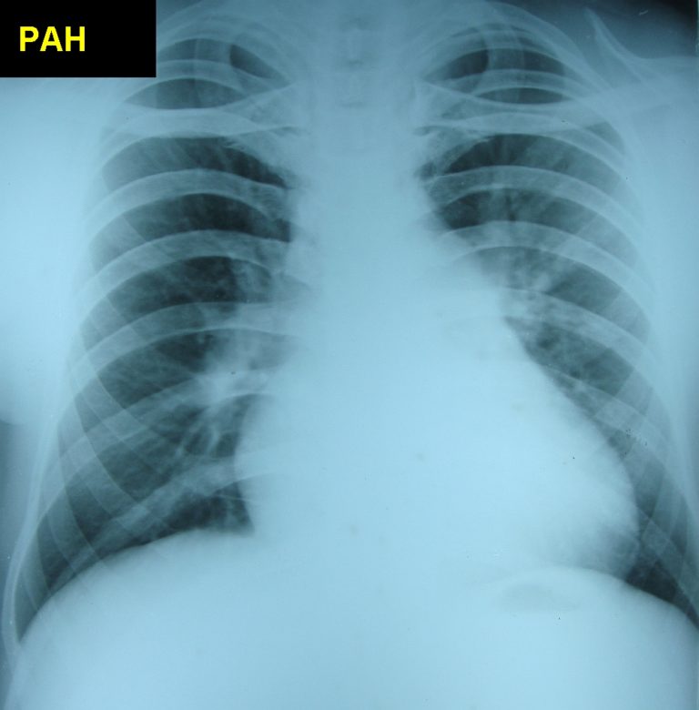 Pulmonary hypertension – progressive – on serial chest X-rays