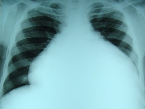 X-ray chest PA view in right ventricular endomyocardial fibrosis with pericardial effusion