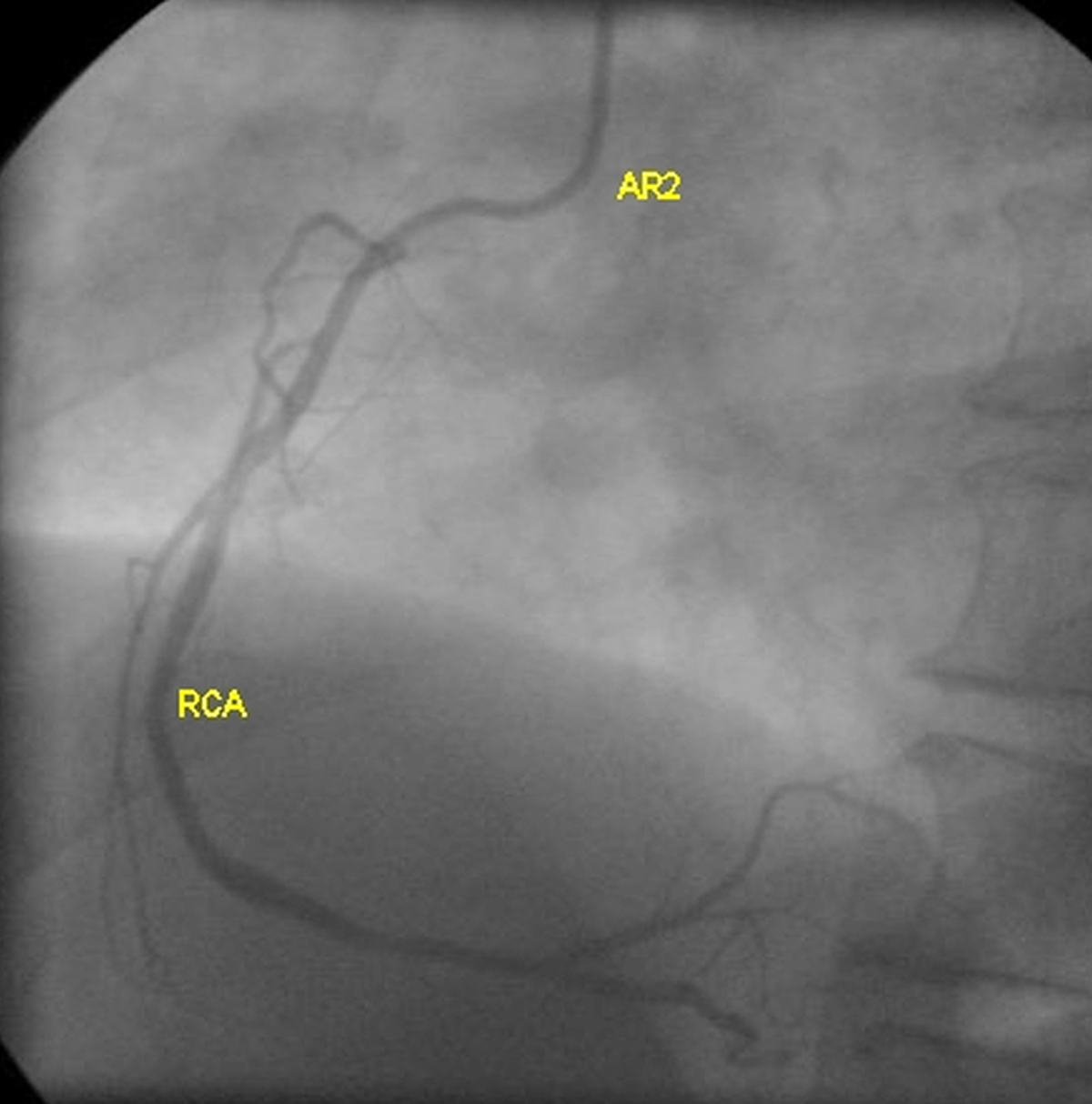 Right coronary angiogram in LAO cranial view using Amplatz RCA catheter