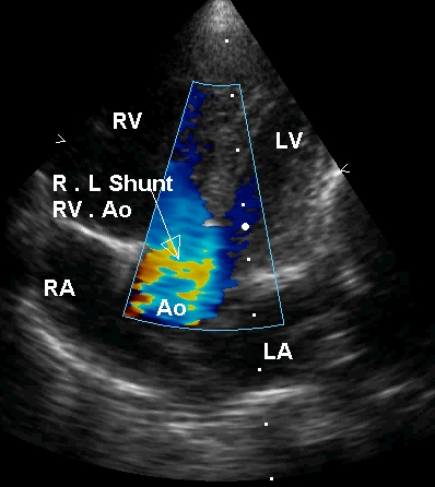 Apical five chamber view in Tetralogy of Fallot in systole with right to left shunt
