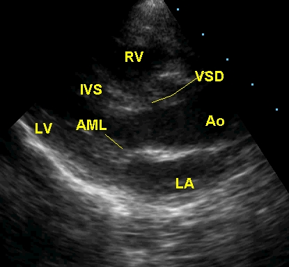 Parasternal long axis view in Tetralogy of Fallot in systole