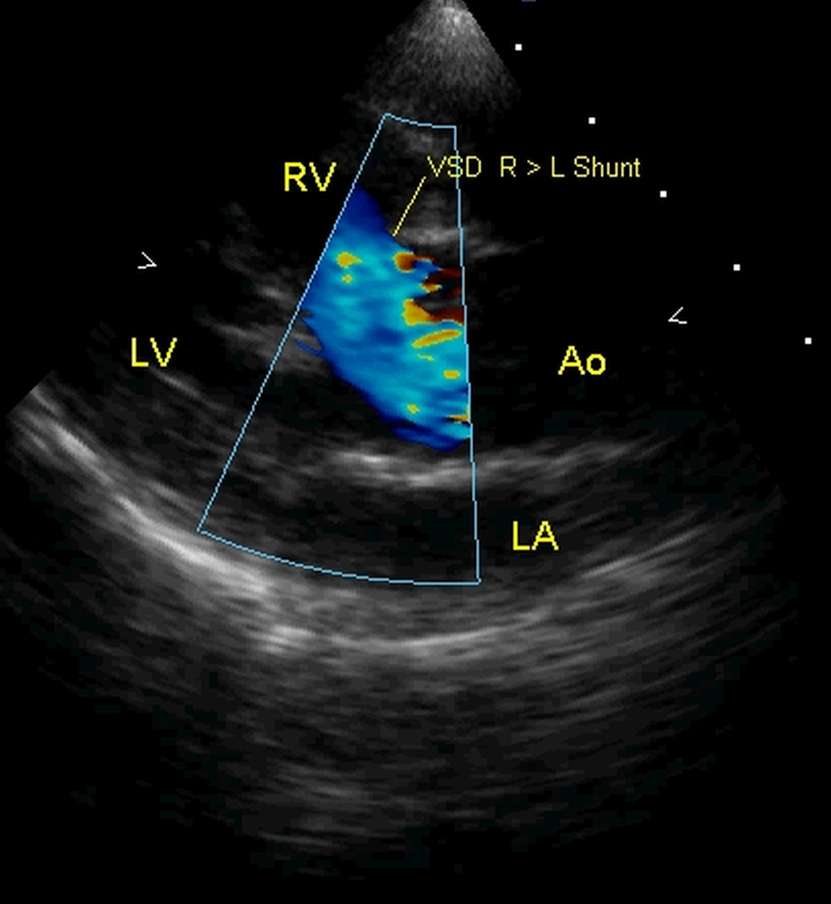 Tetralogy of Fallot with right to left shunt across the ventricular septal defect