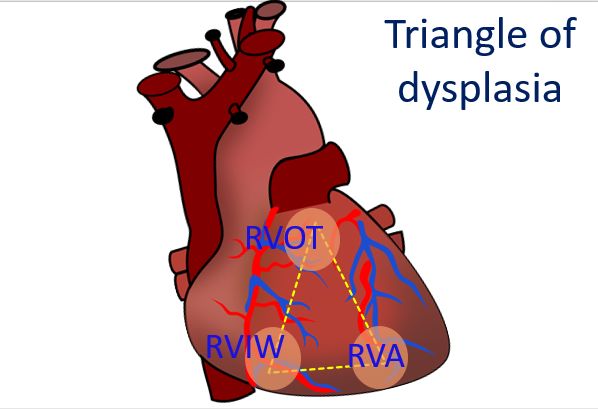 Triangle of dysplasia in ARVD