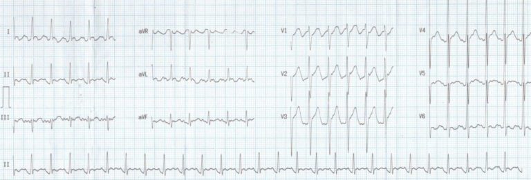 difference between typical and atypical atrial flutter