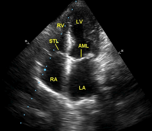 Apical four chamber view with mitral valve fully closed