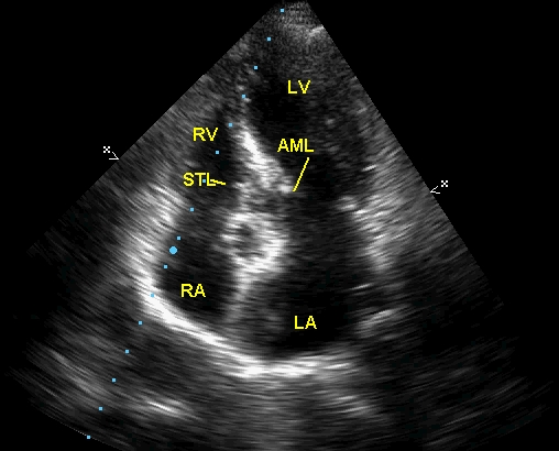Apical four chamber view showing fully open mitral and tricuspid valves