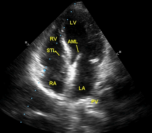 Apical four chamber view with mitral valve partially open